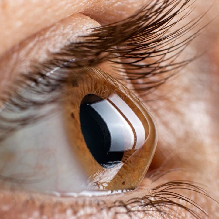 Nahaufnahme eines menschlichen Auges mit Keratokonus, brauner Iris und reflektierender Oberfläche.